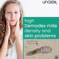 High Demodex mite density and skin problems: PickP