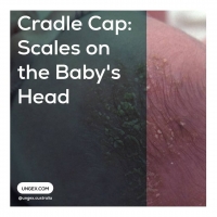 Cradle Cap: Scales on the Baby's Head