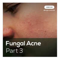 Fungal Acne-Part3 PickP