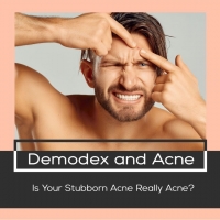 Demodex And Acne