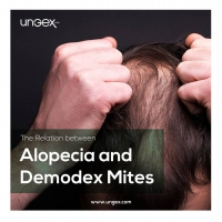 The Relation between Alopecia and Demodex Mites