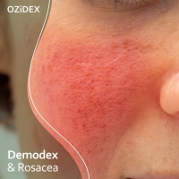 What is Demodex Rosacea?