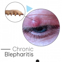 Chronic Blepharitis PickP