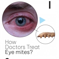 How do Doctors Treat Eye mites?