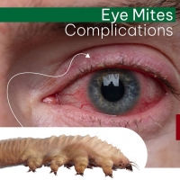 Eye Mites Complications