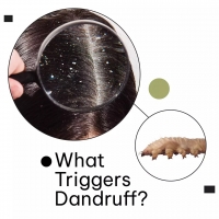 What Triggers Dandruff?