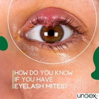 How Do You Know if You Have Eyelash Mites? PickP