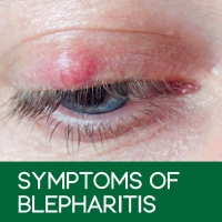 Symptoms of Blepharitis